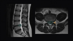 Causes Chronic Lower Back Pain
