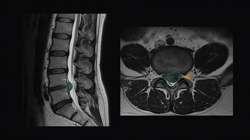 Causes Chronic Lower Back Pain