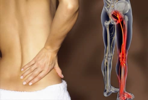Sciatica Explained Back Pain Radiates